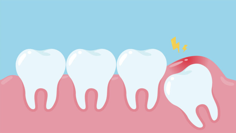 Wisdom teeth removal